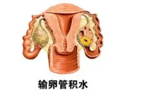  輸卵管積水