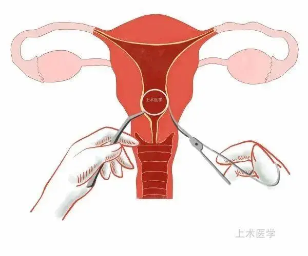 上環取環